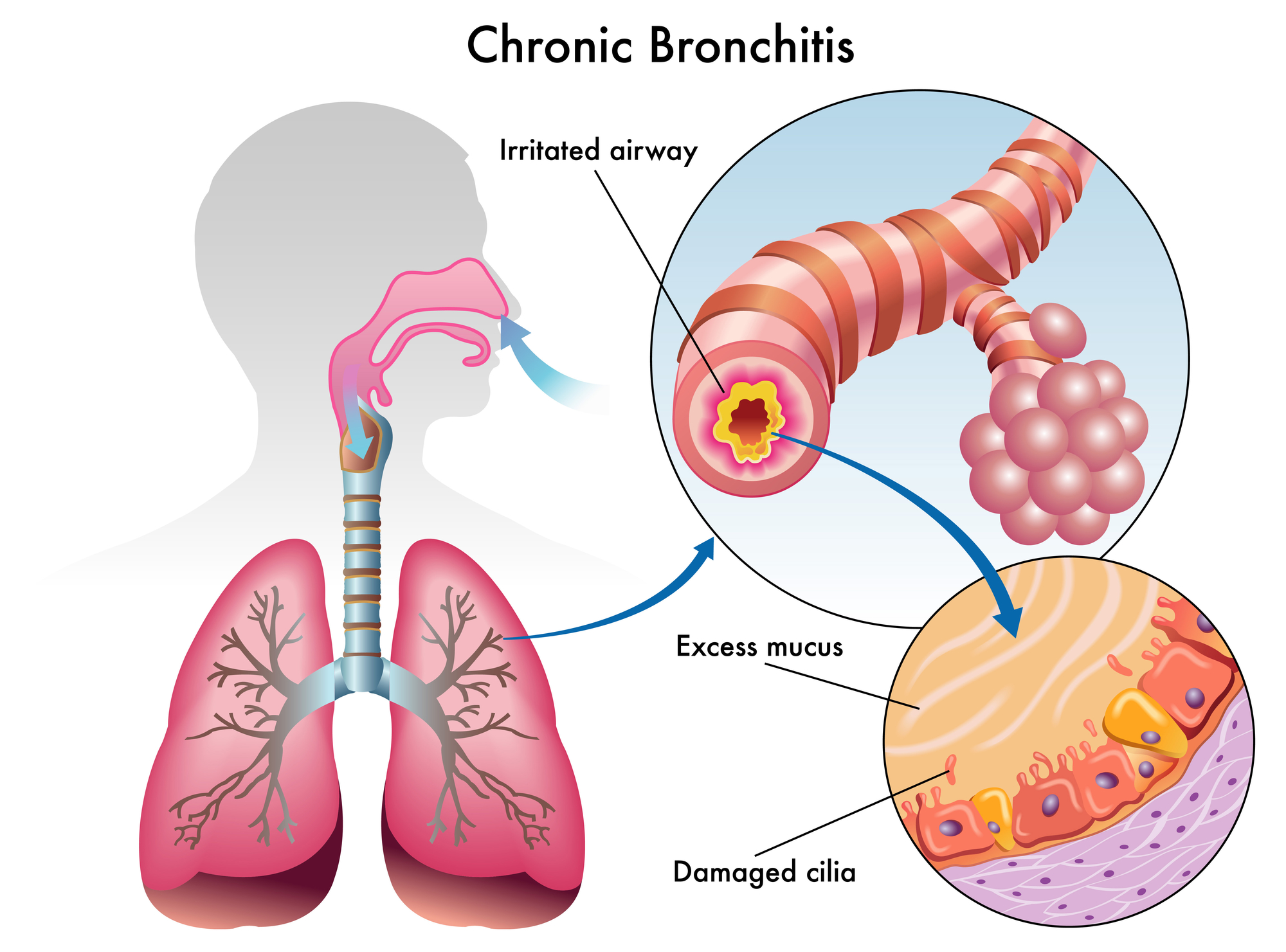 chronic-bronchitis-copd.jpg
